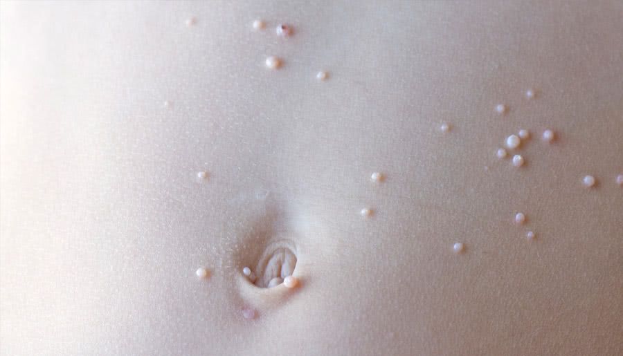 Molusco contagioso