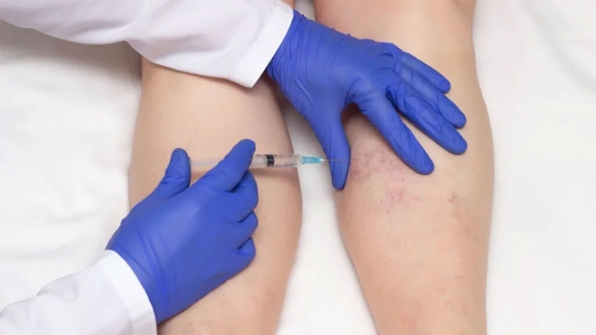 Escleroterapia (várices)