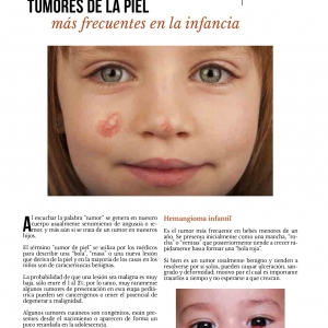  - láser para estrías, exilis elite facial