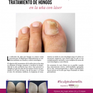  - procedimientos, light sheer