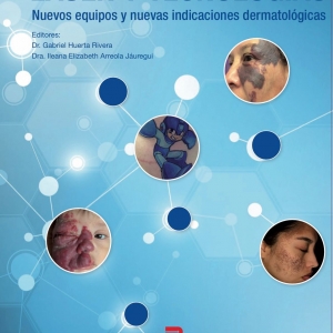  - laser colorante pulsado,zapopan