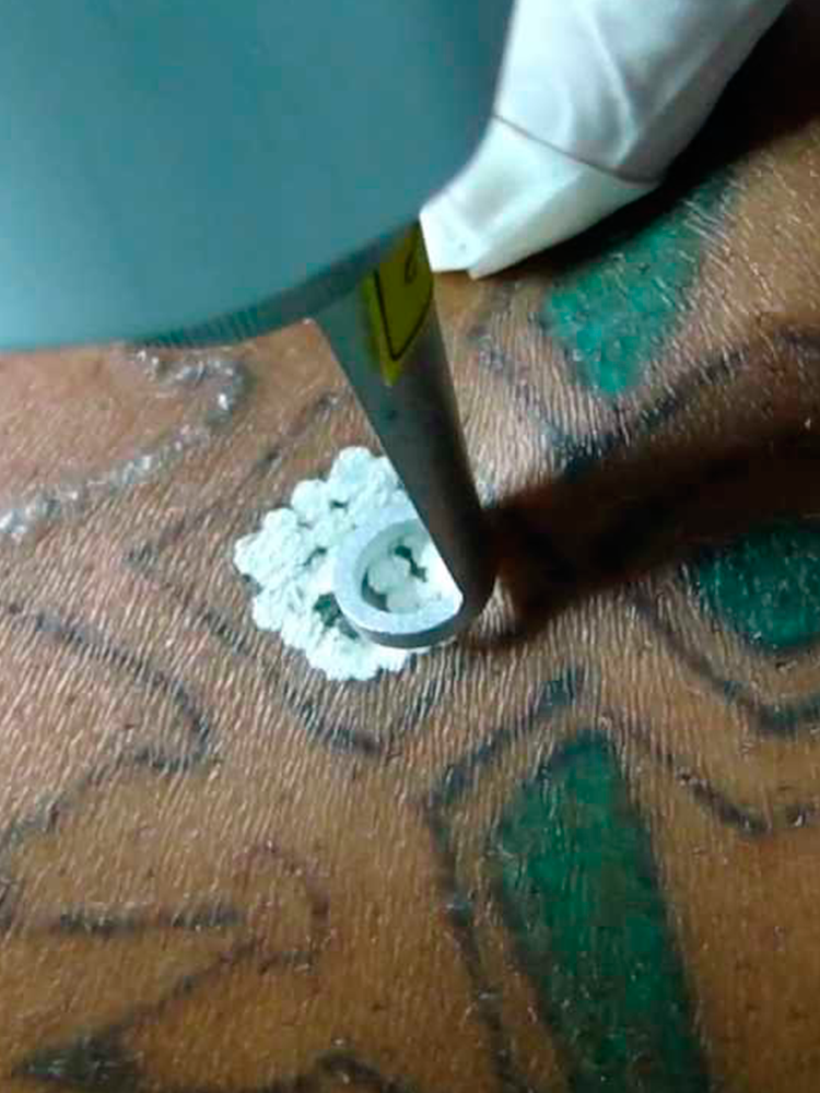 Eliminación de Tatuajes con Láser