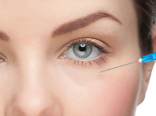 Corrección de hundimiento (surco de ojeras)